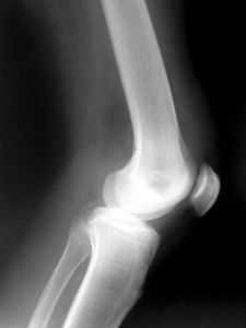 x-ray of human knee